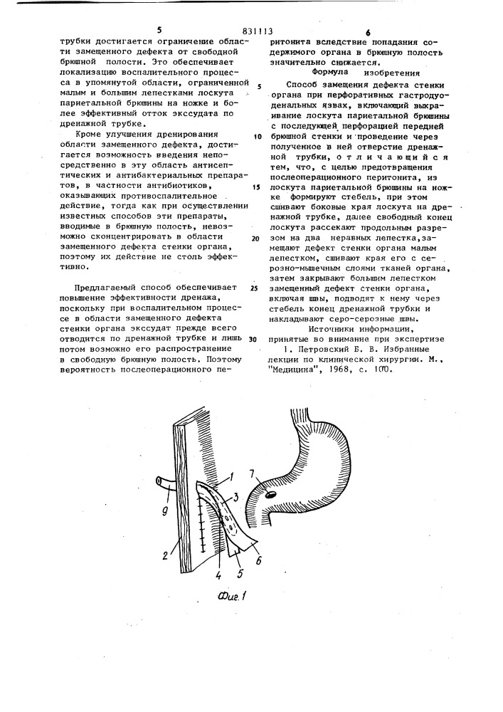 Способ замещения дефекта стенки орга-ha при перфоративных гастродуоденальныхязвах (патент 831113)