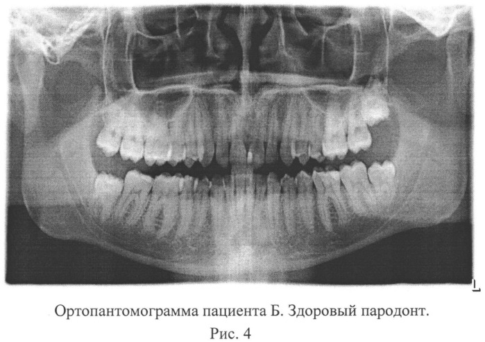 Способ оценки степени тяжести заболевания пародонта (патент 2546102)