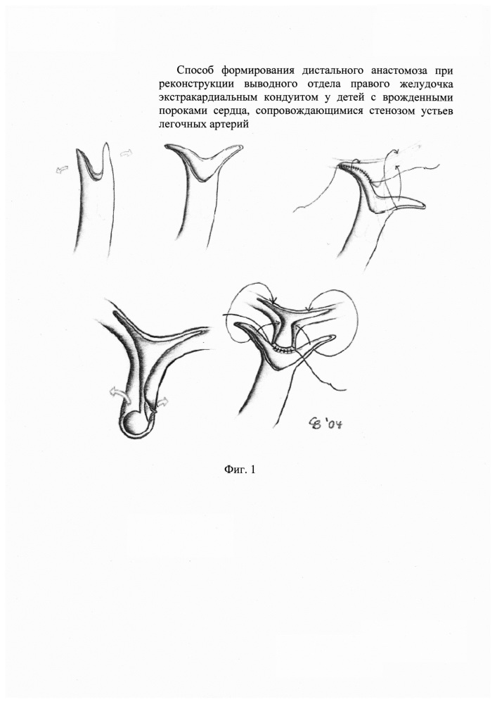 Способ формирования дистального анастомоза при реконструкции выводного отдела правого желудочка экстракардиальным кондуитом у детей с врожденными пороками сердца, сопровождающимися стенозом устьев легочных артерий (патент 2639030)