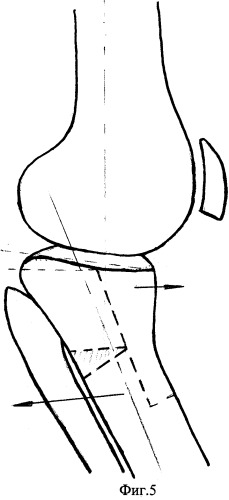 Способ внесуставной коррекции деформаций коленного сустава (патент 2316281)