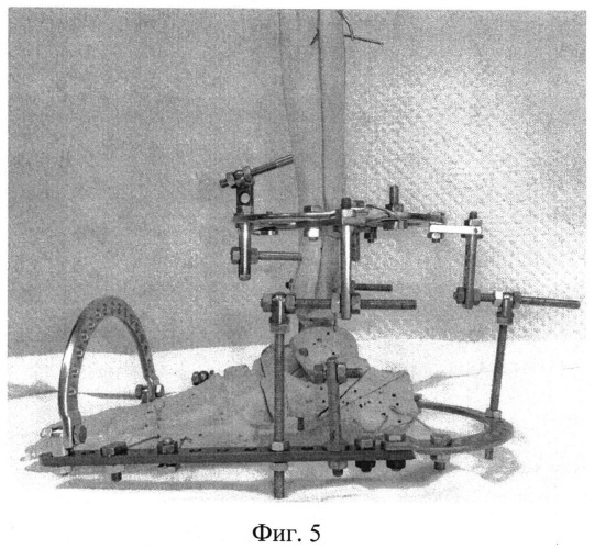 Способ остеосинтеза аппаратом орто-сув для устранения вывихов в голеностопном суставе (патент 2547798)