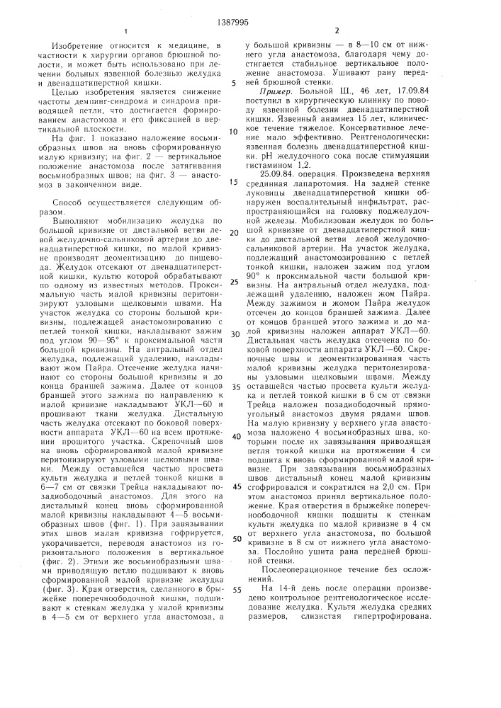 Способ резекции желудка (патент 1387995)