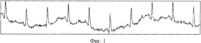 Способ представления электрокардиосигнала (патент 2363379)