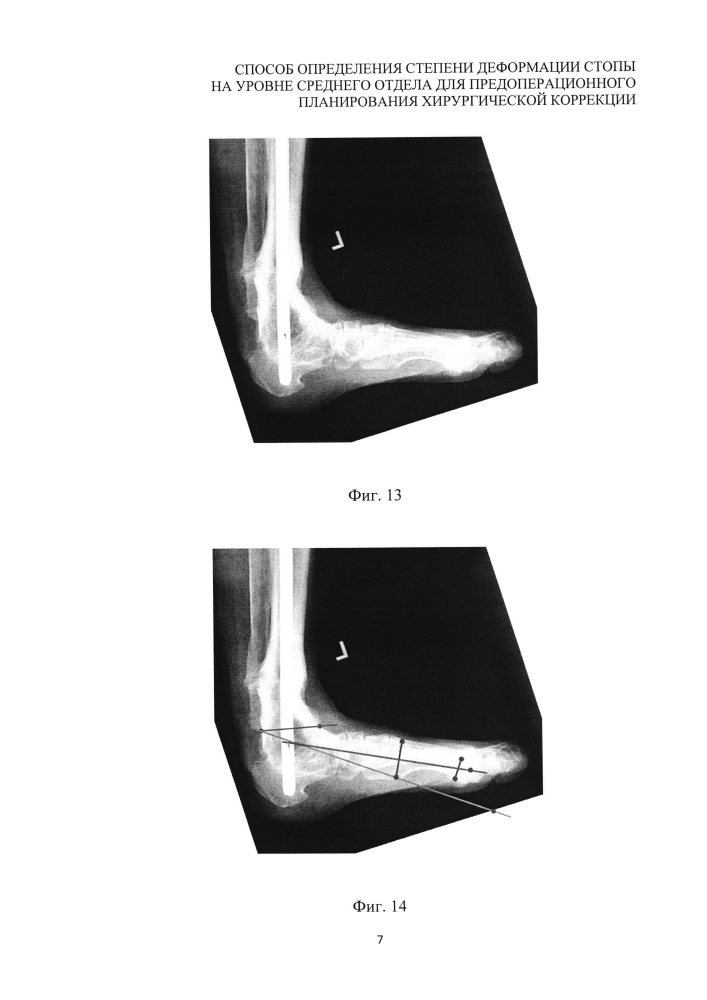 Способ предоперационного планирования хирургической коррекции деформации стопы на уровне среднего отдела (патент 2639430)