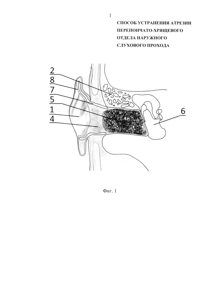 Способ устранения атрезии перепончато-хрящевого отдела наружного слухового прохода (патент 2621948)
