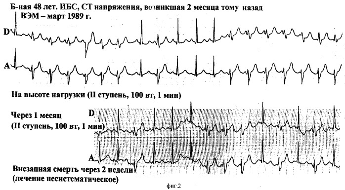 Способ диагностики ишемических желудочковых нарушений ритма у больных ишемической болезнью сердца (патент 2280402)