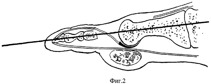 Способ артропластики плюснефаланговых суставов (патент 2351292)