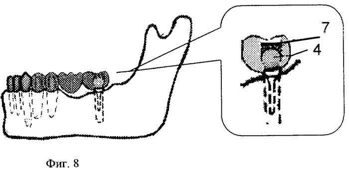Способ соединения имплантата с несъемной конструкцией комбинированного мостовидного протеза (патент 2265416)