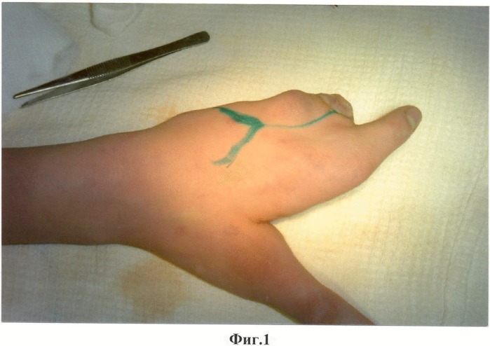 Способ лечения врожденного расщепления трехпалой кисти, сочетающегося с апикально-боковым синостозом и синдактилией первого и второго лучей кисти (патент 2368345)