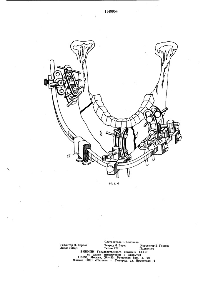 Устройство для остеосинтеза переломов нижней челюсти (патент 1149954)