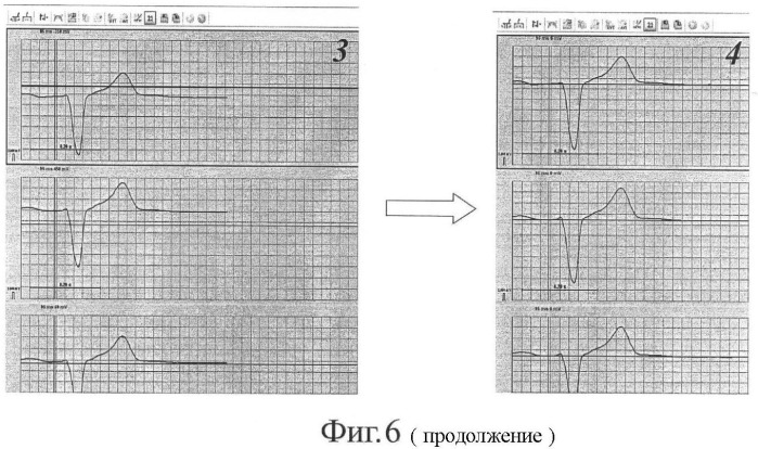 Способ неинвазивного электрофизиологического исследования сердца (патент 2409313)