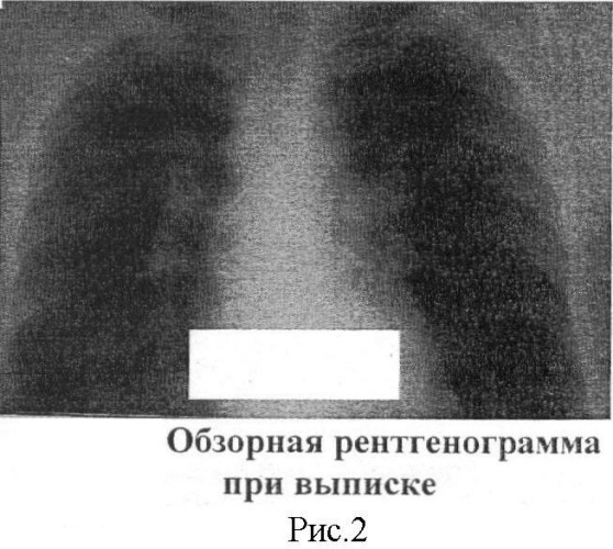 Способ лечения деструктивного туберкулеза легких (патент 2450820)