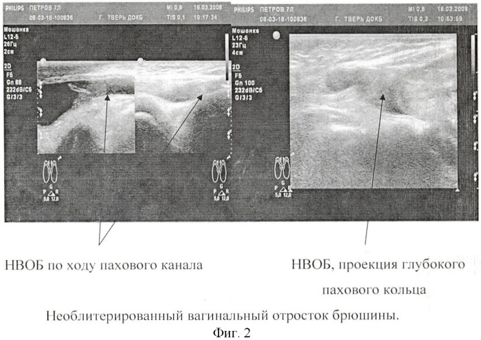 Способ определения показаний к выбору метода оперативного лечения водянки оболочек яичка у детей по данным комплексного ультразвукового исследования (патент 2438594)