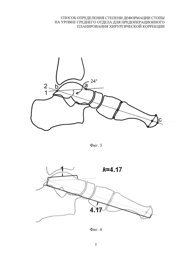 Способ предоперационного планирования хирургической коррекции деформации стопы на уровне среднего отдела (патент 2639430)