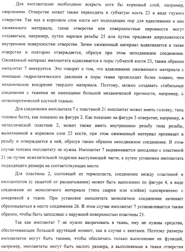 Имплантаты для создания соединений с тканями, в частности со скелетом, а также устройство и способ имплантации (патент 2314768)