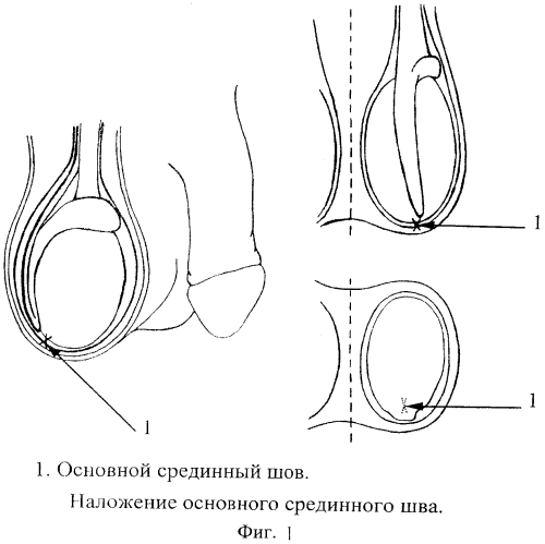 Способ профилактики заворота яичка (патент 2561298)