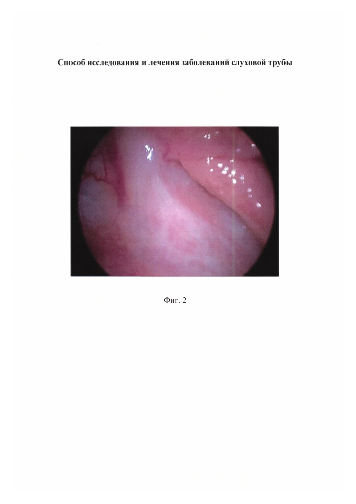 Способ исследования и лечения заболеваний слуховой трубы (патент 2630352)