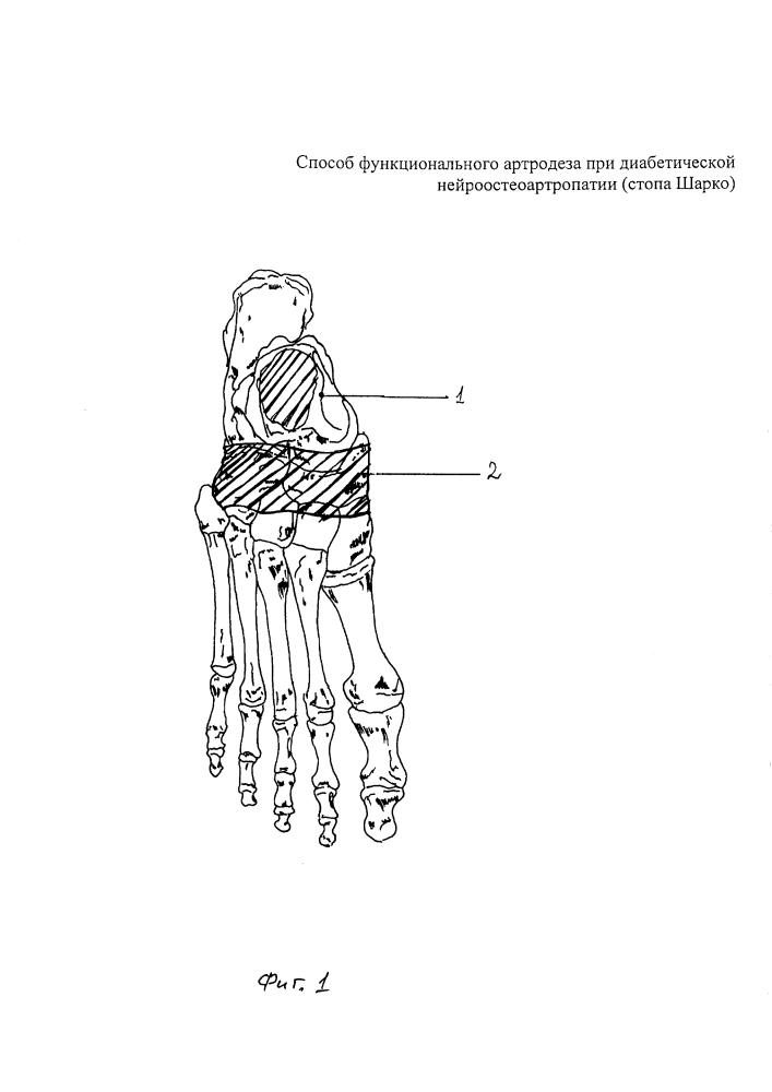 Способ функционального артродеза при диабетической нейроостеоартропатии (стопа шарко) (патент 2604383)