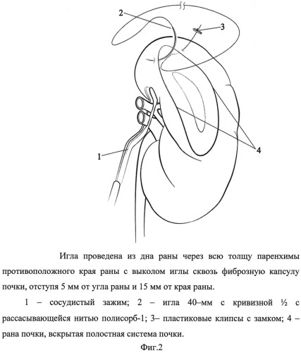 Способ ушивания раны почки при лапароскопическом органосохраняющем лечении рака почки в условиях тепловой ишемии (патент 2532897)
