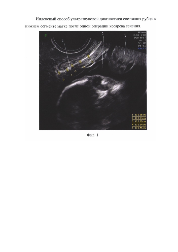 Способ оценки состояния рубца на матке после одной операции кесарева сечения (патент 2648878)