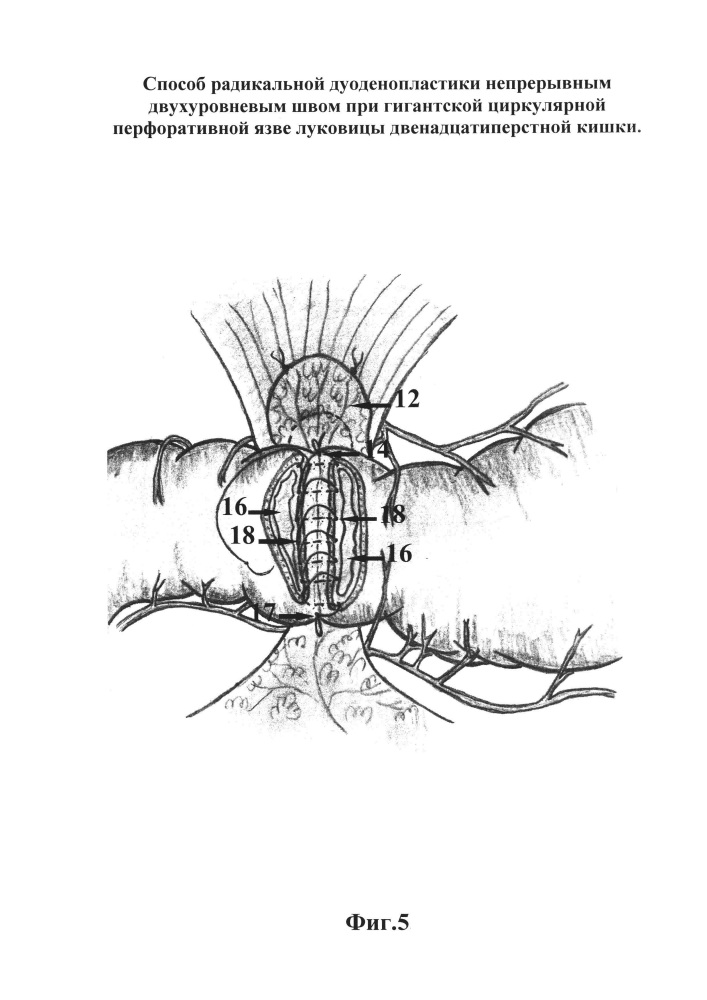 Способ радикальной дуоденопластики непрерывным двухуровневым швом при гигантской циркулярной перфоративной язве луковицы двенадцатиперстной кишки (патент 2664176)