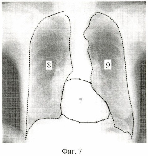 Способ определения контура сердца на флюорографических снимках (патент 2478337)
