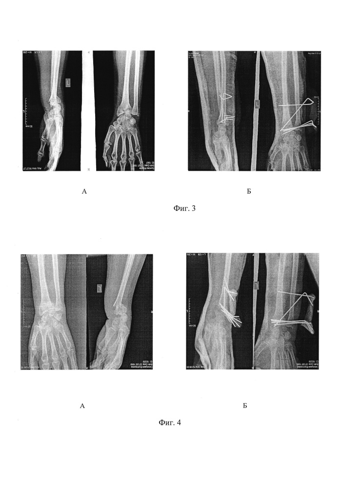 Способ лечения переломов дистального отдела предплечья (патент 2644848)