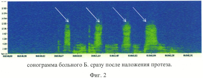 Способ определения восстановления фонетической функции после протезирования зубов (патент 2545418)