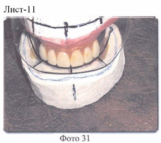 Миодинамический мягкий полный съемный протез. способ изготовления миодинамического мягкого полного съемного протеза (патент 2384308)