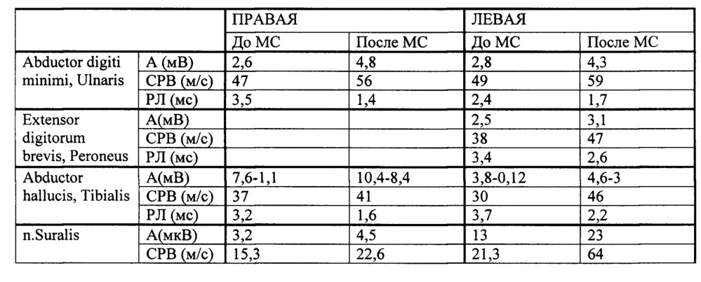 Способ восстановления функции нервов (патент 2662657)