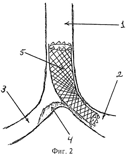 Способ стентирования бифуркации трахеи (патент 2465850)