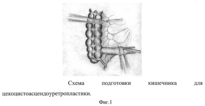 Способ цекоцистоасцендоуретропластики при экстрофии клоаки (патент 2400154)