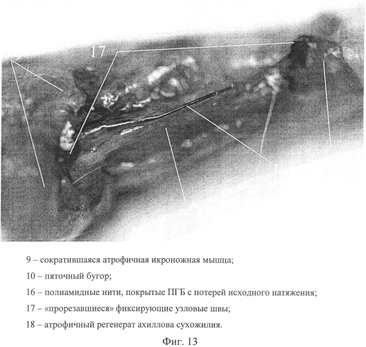 Способ повышения регенерационного потенциала имплантатов для восстановительной хирургии соединительной ткани (патент 2561830)