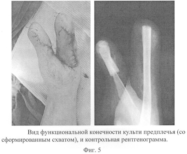 Способ создания функциональности культи предплечья (патент 2402988)