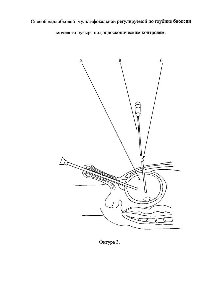 Способ надлобковой мультифокальной регулируемой по глубине биопсии мочевого пузыря под эндоскопическим контролем (патент 2641838)