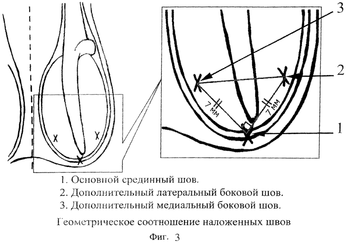 Способ профилактики заворота яичка (патент 2561298)