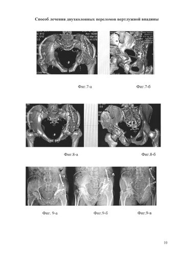 Способ лечения двухколонных переломов вертлужной впадины (патент 2581270)