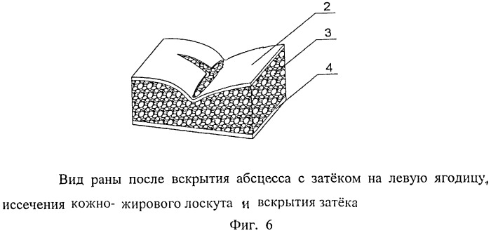 Одноэтапный метод хирургического лечения эпителиального копчикового хода (патент 2499562)