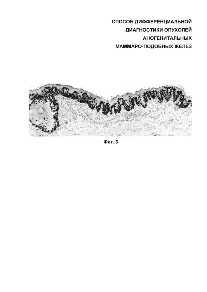 Способ дифференциальной диагностики опухолей аногенитальных маммароподобных желез (патент 2626123)