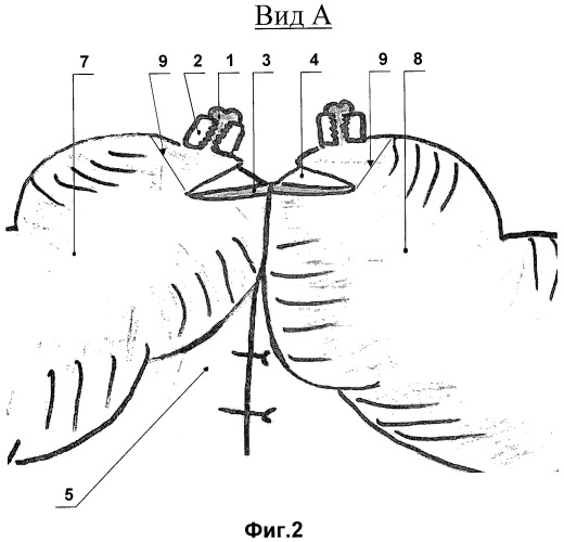 Способ наложения ручного кишечного шва при формировании кишечных анастомозов в абдоминальной хирургии (патент 2432129)