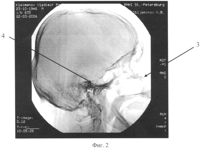 Способ церебральной ангиографии (патент 2348359)