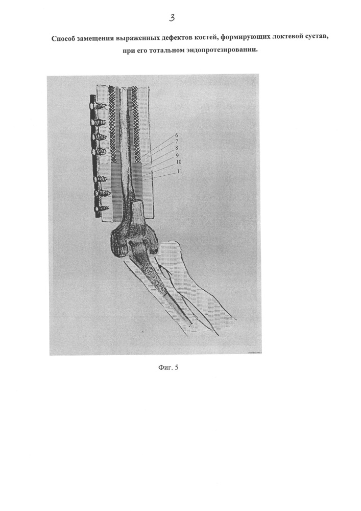 Способ замещения выраженных дефектов костей, формирующих локтевой сустав, при его тотальном эндопротезировании (патент 2662899)