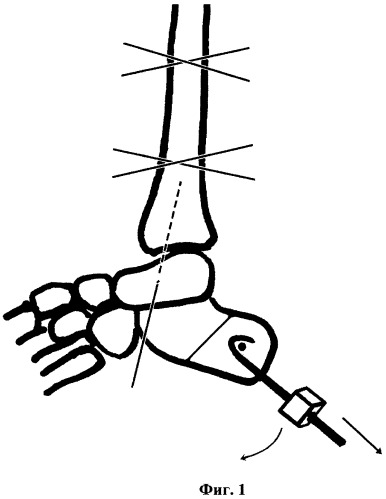 Способ лечения переломов пяточной кости и их последствий (патент 2463011)
