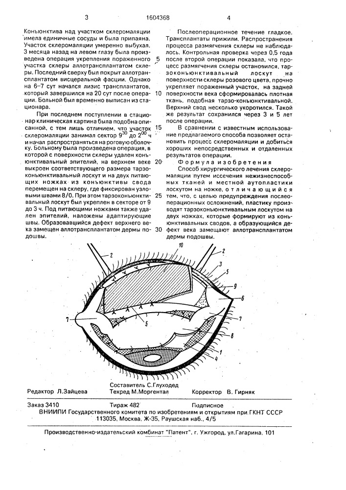 Способ хирургического лечения склеромаляции (патент 1604368)