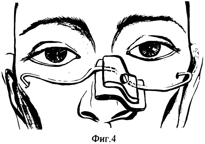 Конструкция для жесткой фиксации костей носа (патент 2274428)