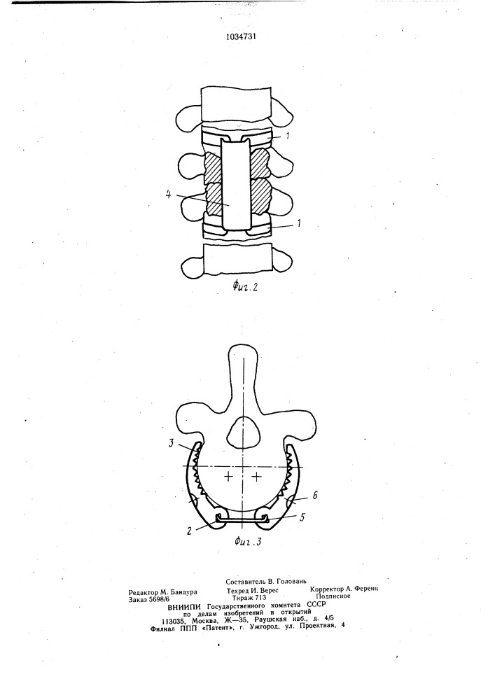 Устройство для фиксации позвоночника (патент 1034731)