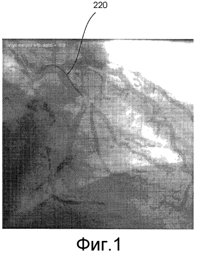 Картирование сосудов (патент 2570758)