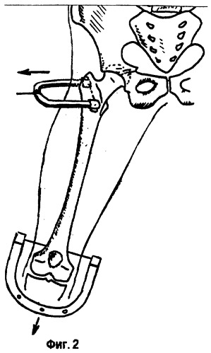 Способ мини-инвазивной боковой скелетной тяги за большой вертел бедра (патент 2266067)