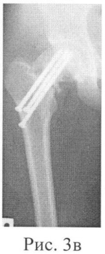 Способ хирургического лечения множественных переломов длинных костей нижних конечностей (патент 2414183)