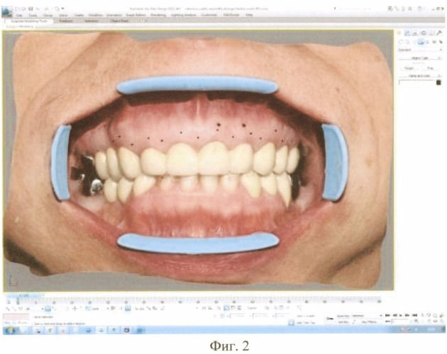 Способ создания трехмерного дизайн-проекта краевого пародонта (патент 2508068)
